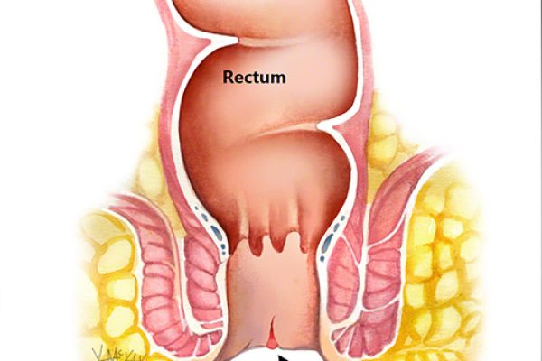 Anal-Fissure-2