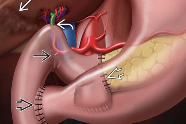 CHOLEDOCHOJEJUNOSTOMY