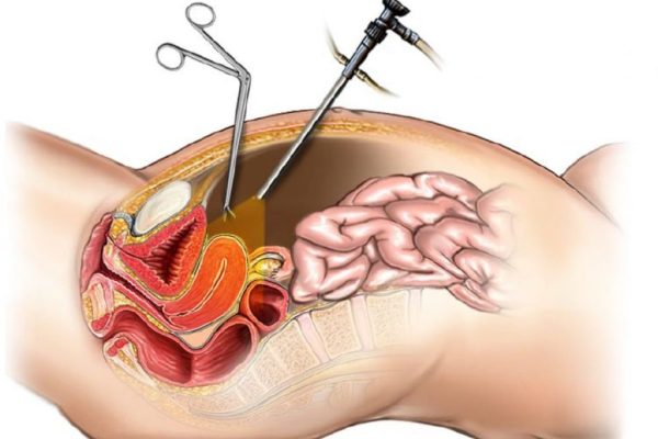 LAPAROSCOPIC OVARIAN CYSTECTOMY