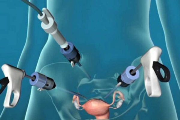 LAPAROSCOPIC SPLEENECTOMY (1)