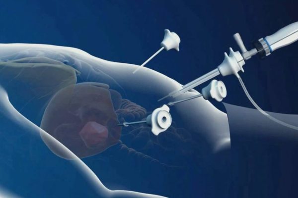 LAPAROSCOPIC