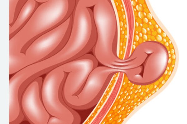 OBSTRUCTED STRANGLULATED HERNI