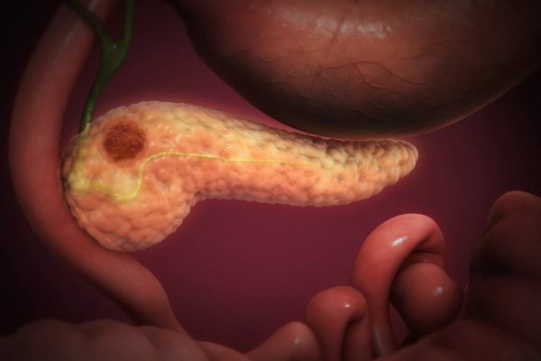 PANCREATIC NECROSIS