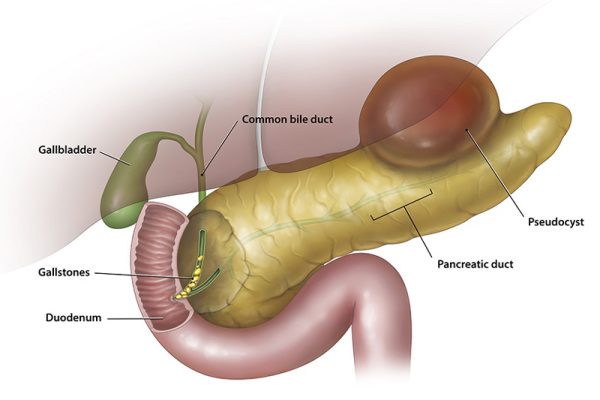 PSEUDOCYST