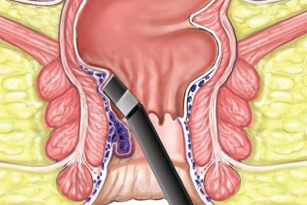 Piles Fistula Laser Treatment