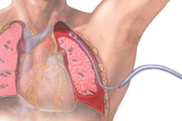 USG GUIDED HEPATIC ABSCESS DRAINAGE