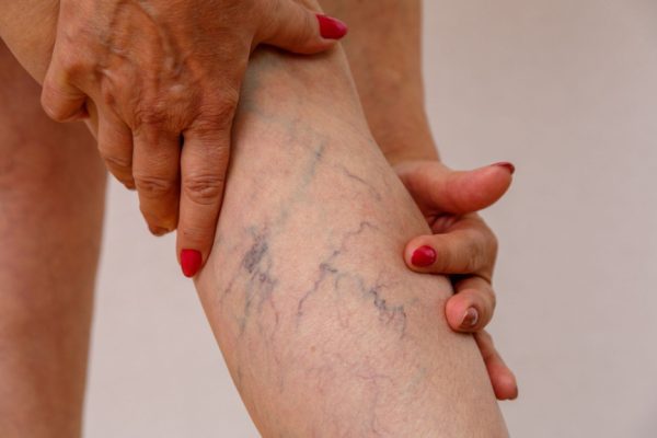 VARICOSE VEIN
