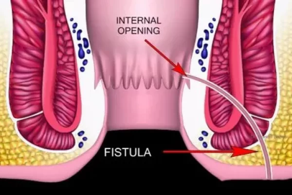 anal-fistula-treatment-service-500x500